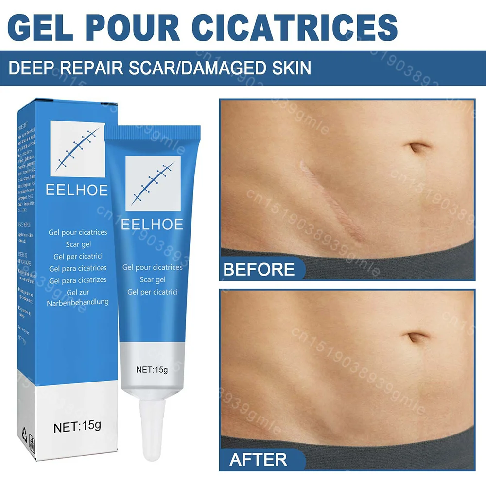 Scar repair gel fast recovery surgery Scar treatment Spot repair Soften stretch mark Burn Whitening body care Relief