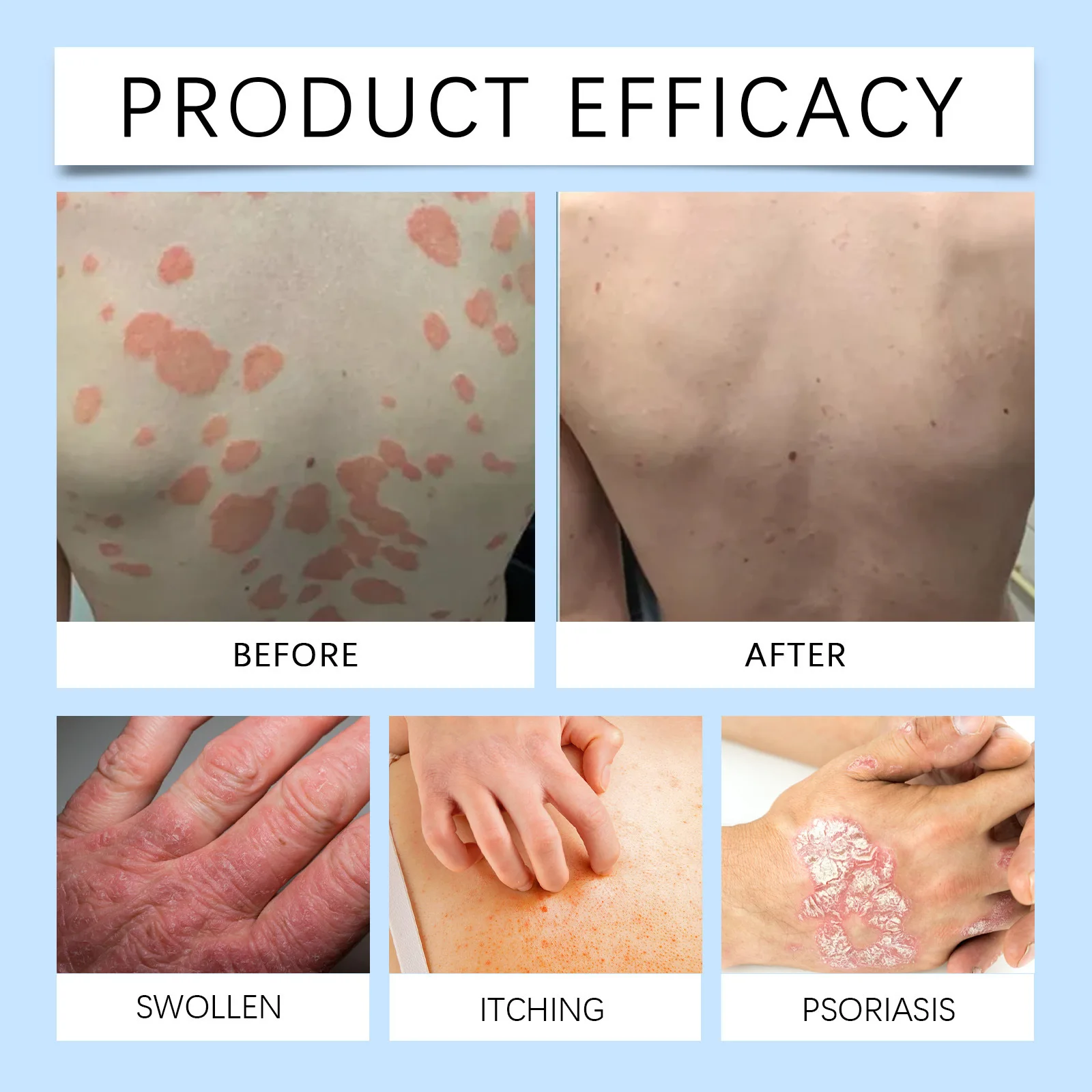 Psoriasis Treatment Ointment Relieve Dermatitis Eczema Urticaria Swell Itch Antipruritic Antibacterial Alergy Red Rash Skin Care