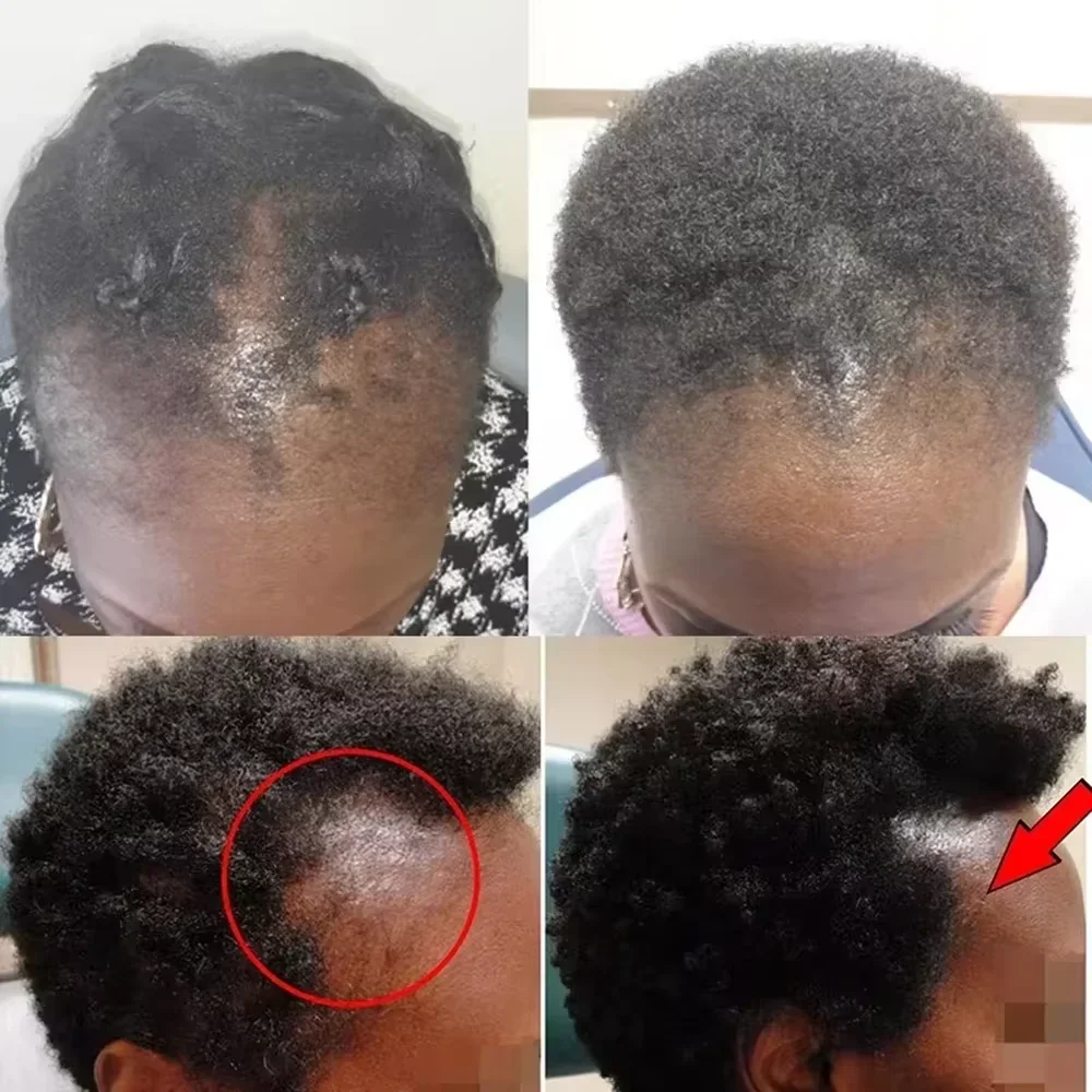 Fast Hair Growth Set Batana Oil Traction Alopecia HairS Mask Anti Break Loss Hair Growth Oil Baldness Treatment Hair Health Care 2 Fast Hair Growth Set Batana Oil Traction Alopecia HairS Mask Anti Break Loss Hair Growth Oil Baldness Treatment Hair Health Care - Image 2