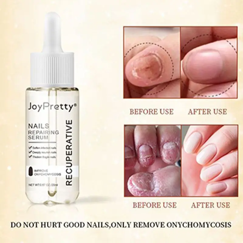 Nail fungus remover 20ml Nail Repairing Serum