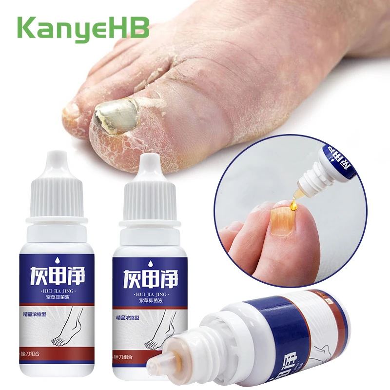 

3Pcs Nail Fungus Treatment Liquid Onychomycosis Paronychia Anti Infection Toe Fungal Removal Hand Foot Repair Care Liquid A1134
