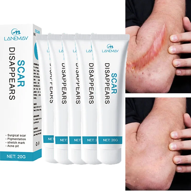 Scar Removal Cream Repair Stretch Marks Burn Acne Surgical Acne Scar