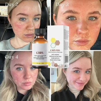 Salicylic Acid Face Facial Peel Neutraliser Face Deep At Home Chemical Peel Exfoliate Refine skin care serum NEW