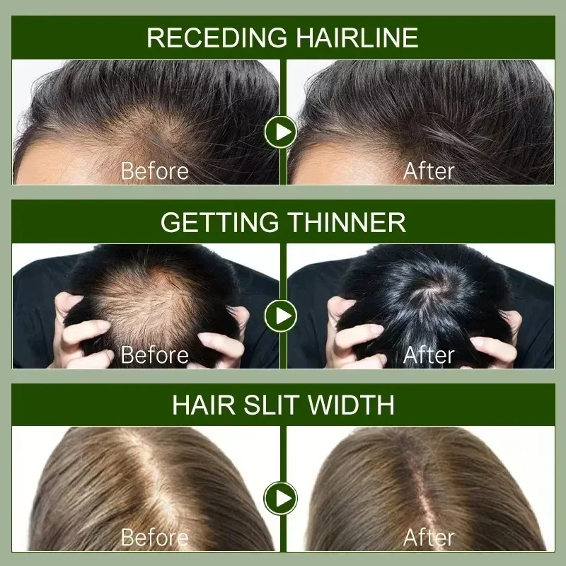 Hair Growth Serum 7 Days Fast Regrowth Essential Capsule Anti Hair loss Baldness Repair Damaged Scalp Treatment For Women Men hair care products,white hair treatment serum