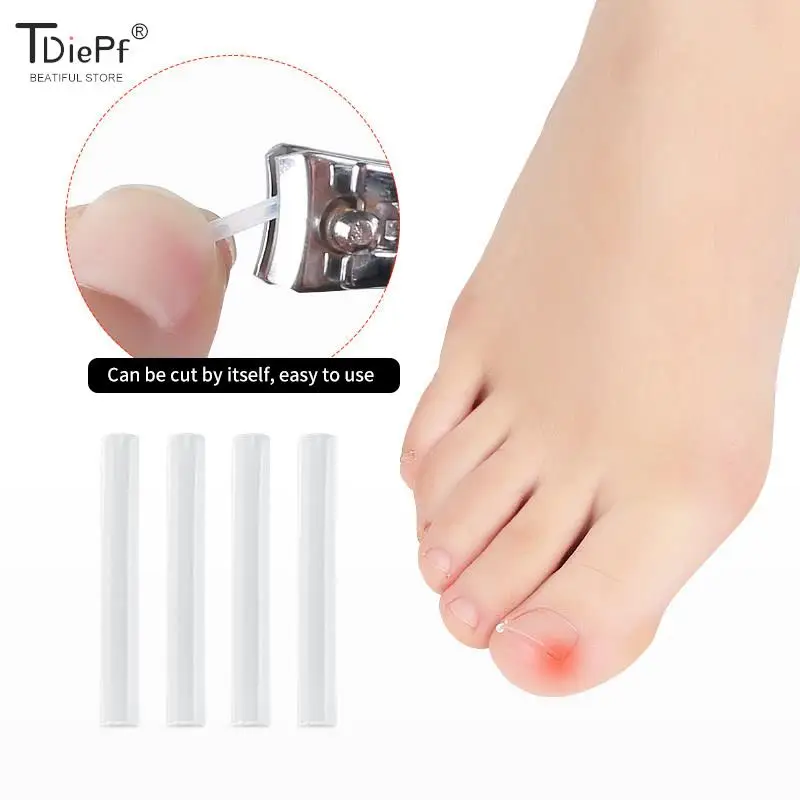 50Pc/box Ingrown Toenail Correction Tool Ingrown Toe Nail Treatment Elastic Patch Sticker Straightening Clip Brace Pedicure Tool 4