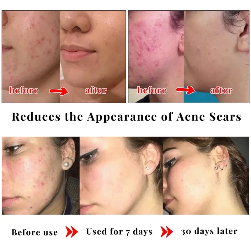 Body Whitening Soap Underarm Knee Bleaching Chicken Skin Removal Dark Spot Removal Dead Skin Moisturize Brighten Body Care body whitening soap