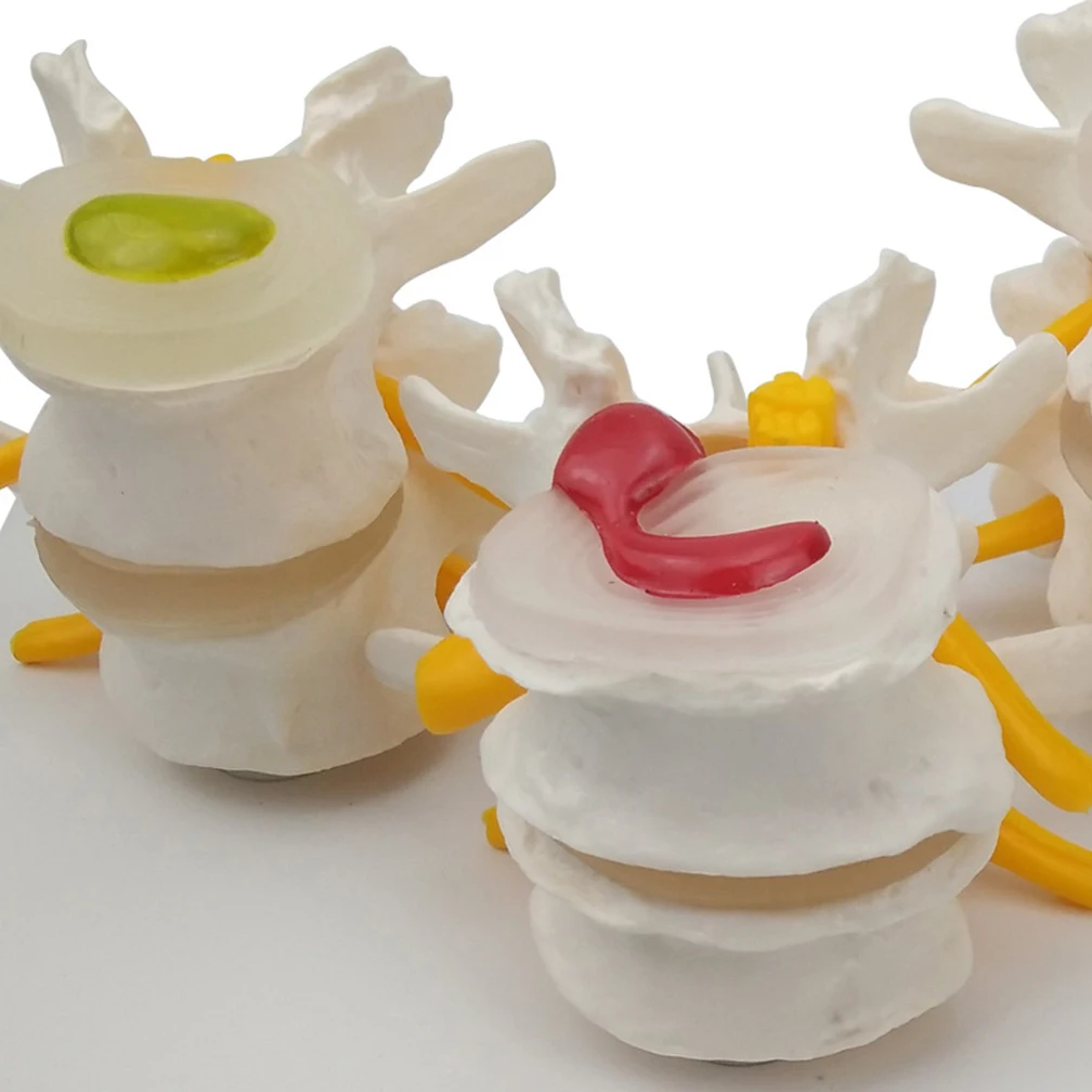 4-stage Pathological Human Lumbar Spine Anatomy Model Medical Science Teaching Resources Orthopedic Teaching Display Tools