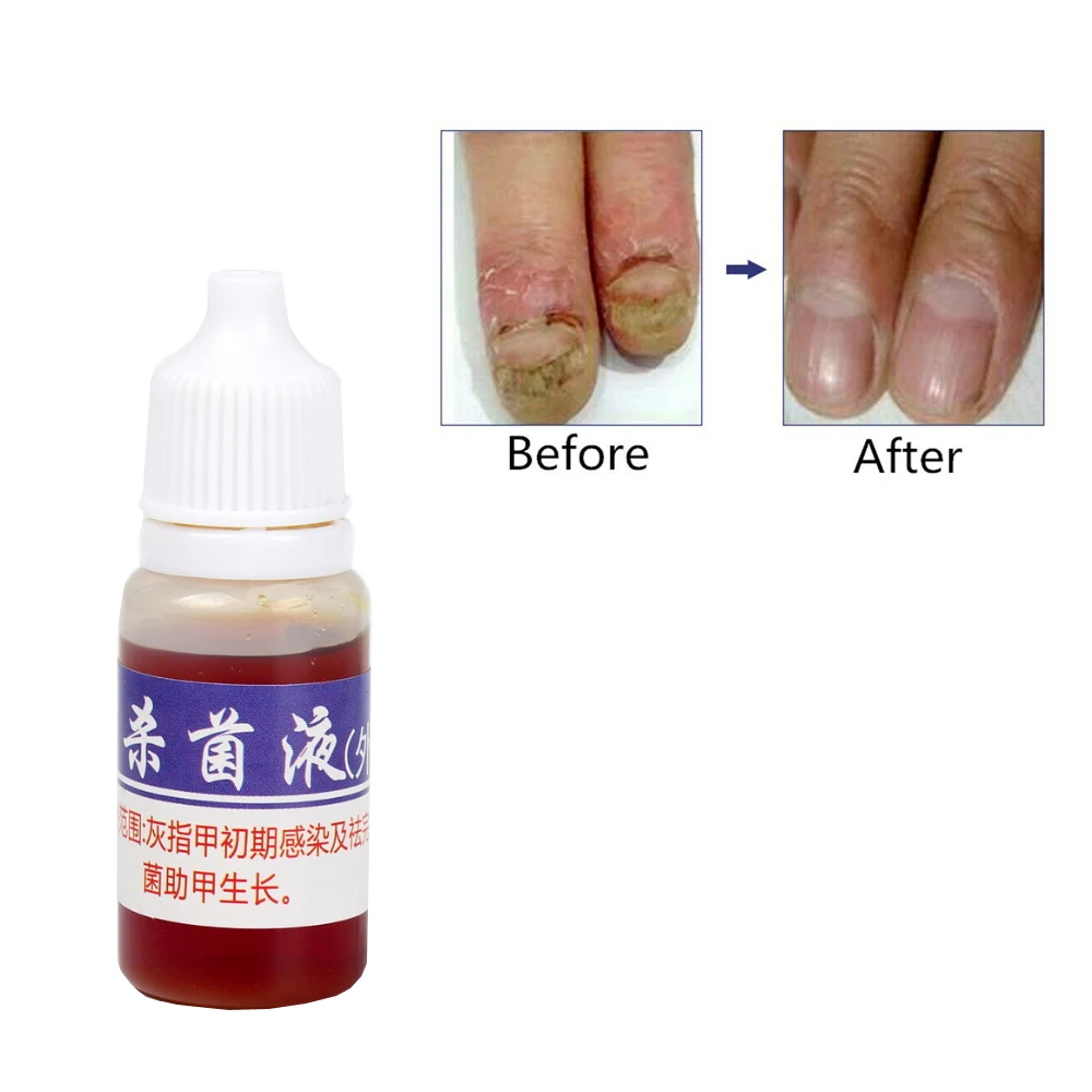 Nail Fungus Remover Anti Infection Fungal Nail Treatment Liquid Gel