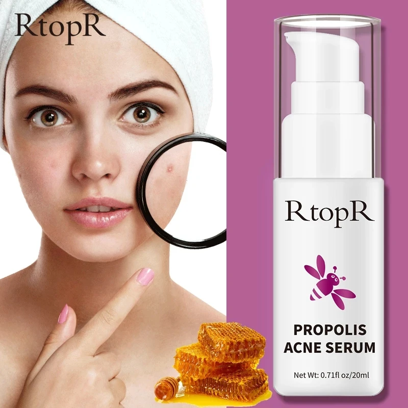 

RtopR Propolis Anti-acne Essence Rich in Vitamin E And Mango Extract Gentle Acne Whitening Moisturizing Treatment Acne Marks