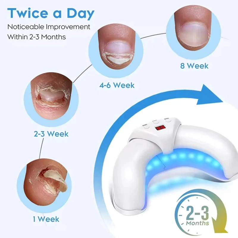 Semi-arc Nail Fungus Laser Device Cure Onychomycosis Toenail Fingernail Fungal Therapy Time display nail fungus remover,laser therapy pen