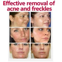 Crème éclaircissante douce à la niacinamide pour le mélasma, atténue efficacement la mélanine, crème blanchissante, élimine les pigments foncés, hydrate la peau 5