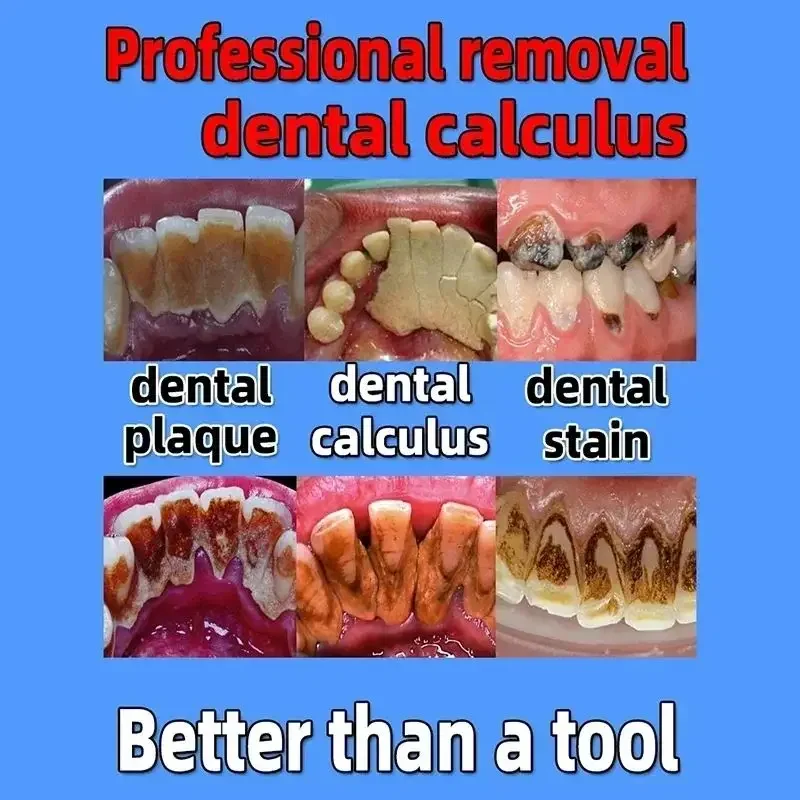 Dental Calculus Remover Whitening Bad Breath Teeth Toothpaste Brightening Preventing Periodontitis