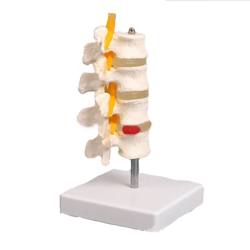 

Human Anatomical Lumbar Disc Herniation Vertebral Spine Anatomy Skeleton Model Nerve Roots Medical Teaching Tool