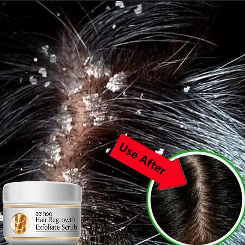 Hair Essence Oil Hair Oil Hair Growth Oil Anti Dandruff Hair Oil Control Relieve Itching Treatment Scalp Cleaning Exfoliating Product Antipruritic Anti Loss Hair