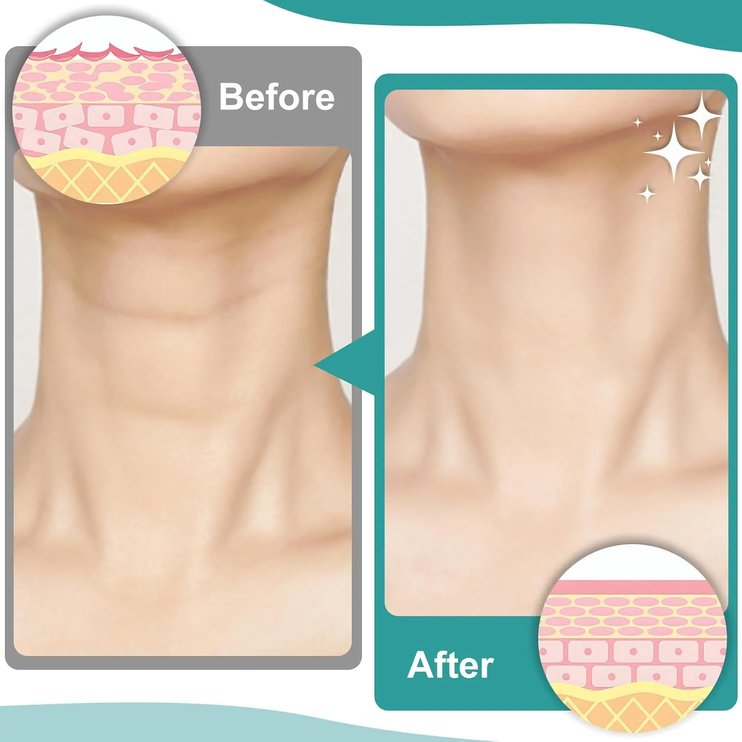 6PCS Reusable Silicone Care Neck Pad Neck Tape Wrinkle Pads for Neck Wrinkle Treatment Prevention Anti Wrinkle Remover