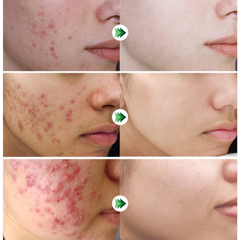Salicylic Acid Facial Serum Acne Removal Treatment Repair Spots Scar Moisturizing Oil Control Shrink Pore Skin Care facial serum,facial essence,whitening serum
