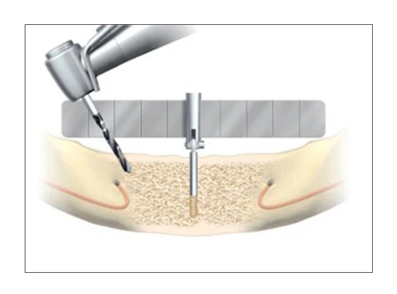 VVDental Implantat-Ortungsanleitung für Zahnarzt, chirurgisches Pflanzen, Winkellineal, Präzisionsmesslineal, biegbares Dentalwerkzeug – Detail 7