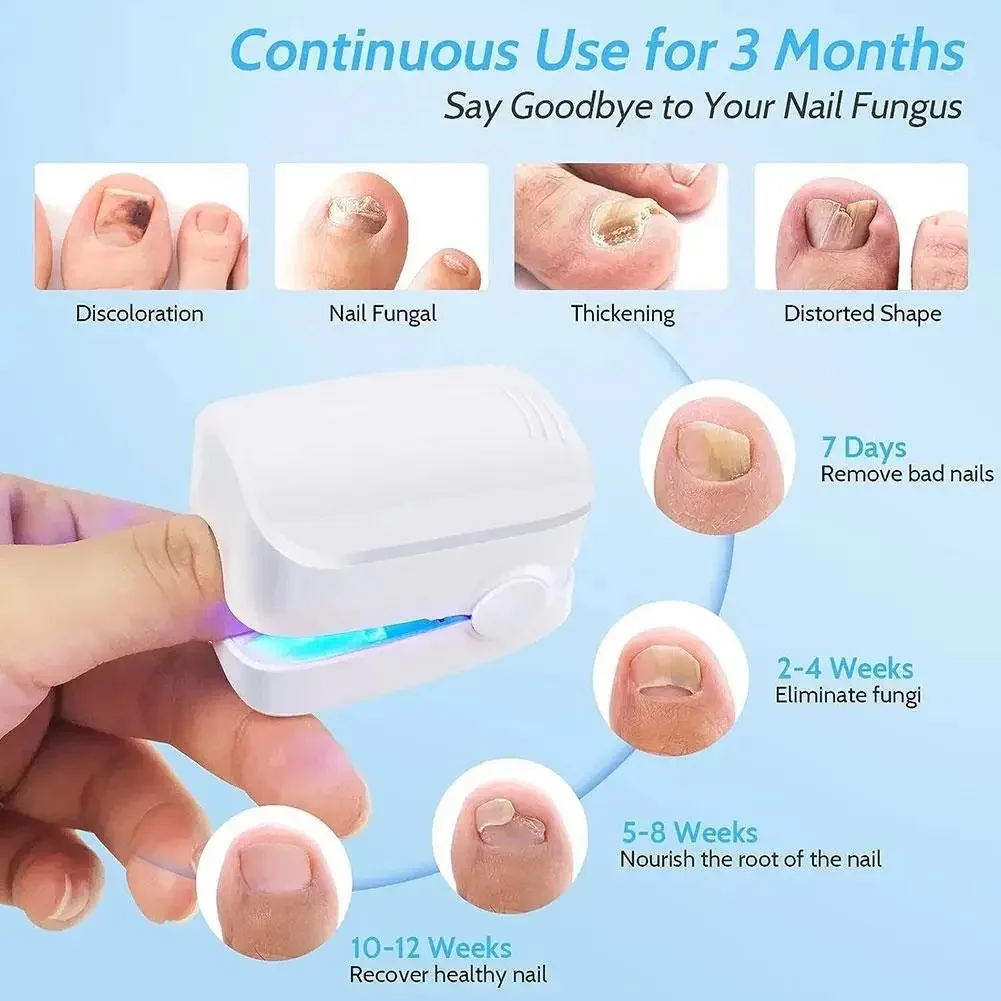 USB rechargeable portable UV remove nail fungus lamp portable auxiliary tool UV Disinfection and killingnail fungus mini lamp