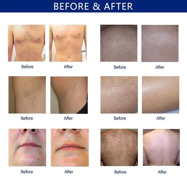 Laser Machine for Hair Removal And Tattoo Removal 7 <h3 class="features--headline">Features and benefits</h3> <ul> <li>Safe and effective -non-invasive non-ablative treatment long-lasting results</li> <li>Intense Pulsed Light - powerful energy control unit and cooling system</li> <li>Q-Switch Nd:YAG laser – effectively treat a wide range of tattoo colors</li> <li>IPL Machine uses - Hair Removal, Skin Rejuvenation, Acne removal</li> </ul> <hr /> <h5></h5> <h5><span class="tw-text-2xl tw-font-bold" style="color: #99ccff;">IN STOCK READY TO SHIP</span></h5> <h5><span class="tw-text-2xl tw-font-bold" style="color: #99ccff;">1 YEAR WARRANTY + 3 YEAR TECH SUPPORT</span></h5> <h5><span class="tw-text-2xl tw-font-bold" style="color: #99ccff;">30 DAY MONEY-BACK AND <a href="https://tattoosemi.com/refund_returns/">RETURN POLICY</a></span></h5> <h5><span class="tw-text-2xl tw-font-bold" style="color: #99ccff;">FREE WORLDWIDE SHIPPING <a href="https://tattoosemi.com/shipping-policy/">SHIPPING POLICY</a> </span></h5> <h5><span class="tw-text-2xl tw-font-bold" style="color: #99ccff;">PROFESSIONAL BEAUTY <a href="https://tattoosemi.com/">SALON MACHINES</a> EQUIPMENT</span></h5> <div class="product-block product-block--sales-point"></div> Laser Machine for Hair Removal And Tattoo Removal