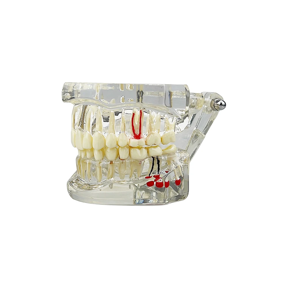 Teeth Repair Model Disease Teeth Model for Dentist Student Practice Training Studying Oral Medical Dentistry Tools