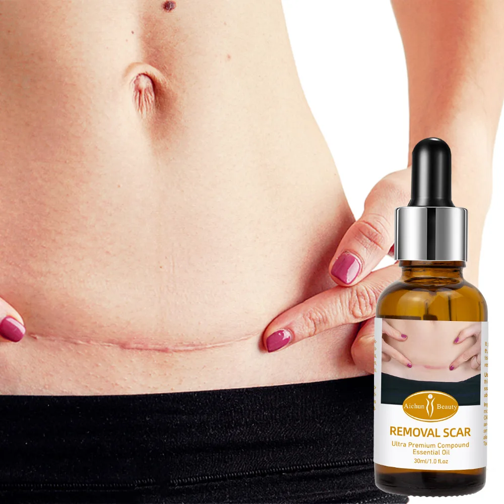 

Scar Removal Essential Oil Effective Treatment Stretch Marks Burns Lighten Acne Spots Section Scars Whiten Skin Care Products