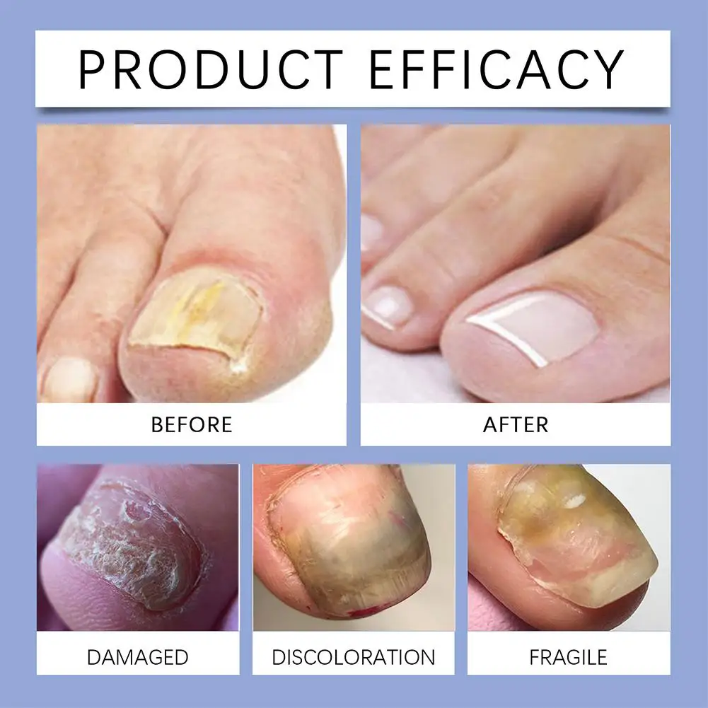 Nail Repairing Liquid Fungus Treatment Essence Care Fungal Gel Paronychia Anti-infective Foot Removal Hand Repair M7C3 50ml