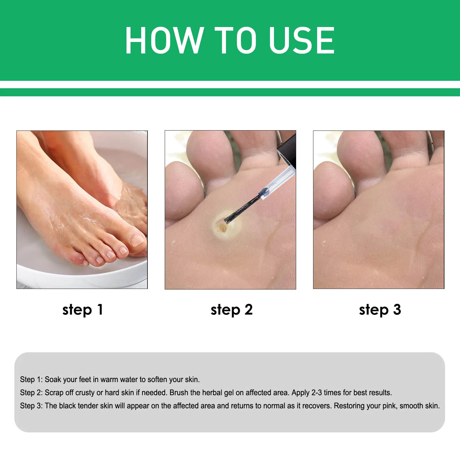 Manicure Pedicure Tools Personal Health Care Pain Analgesic Cream Foot Corn Removal Cream Chicken Eye Skin Infection Treatment Chicken Eye Solution Foot Dead Skin Scab Removal Tool Health발톱무좀