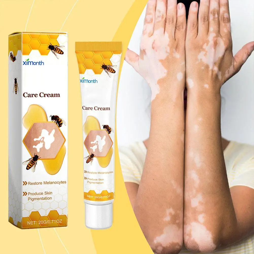 

Средство для ухода за кожей Vitiligo, крем для пчелы, спрей для устранения белых точек, мазь для удаления, 20 г