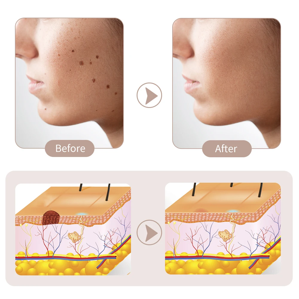 Laser Plasma Pen Mole Wart Eliminator Papilloma Skin Tag Remover Black Dots Freckle Dark Spot Remover Wireless Plasma Pen Beauty