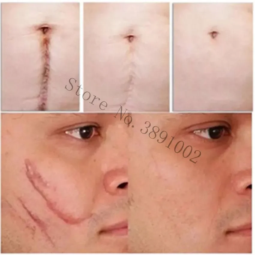 

Natural Authentic Anti Acne Spots Face Anti Care Acne Treatment Scar Removal Oily Skin Acne Spots Skin Care Face Stretch Marks