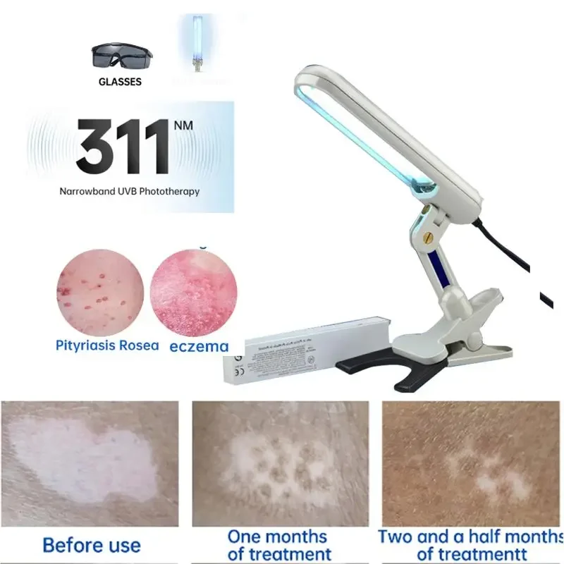 UV Phototherapy Lamp Philips UV lamp for Vitiligo Psoriasis Treatment UV 311nm Ultraviolet Phototherapy Device Uses Lamp UVB To Treat Vitiligo