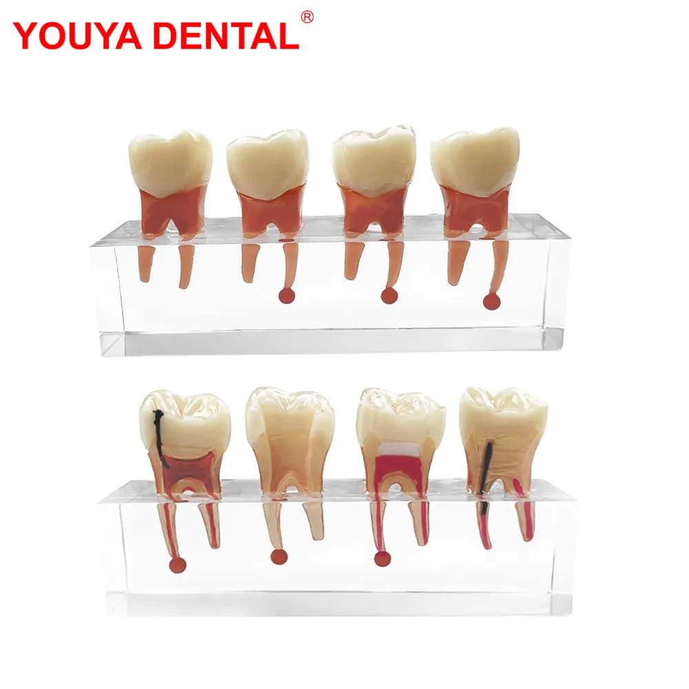 

Dental Model Pathology Transparent Pathological Teeth Model For Studyting Teaching Education Patient Communication Demonstration