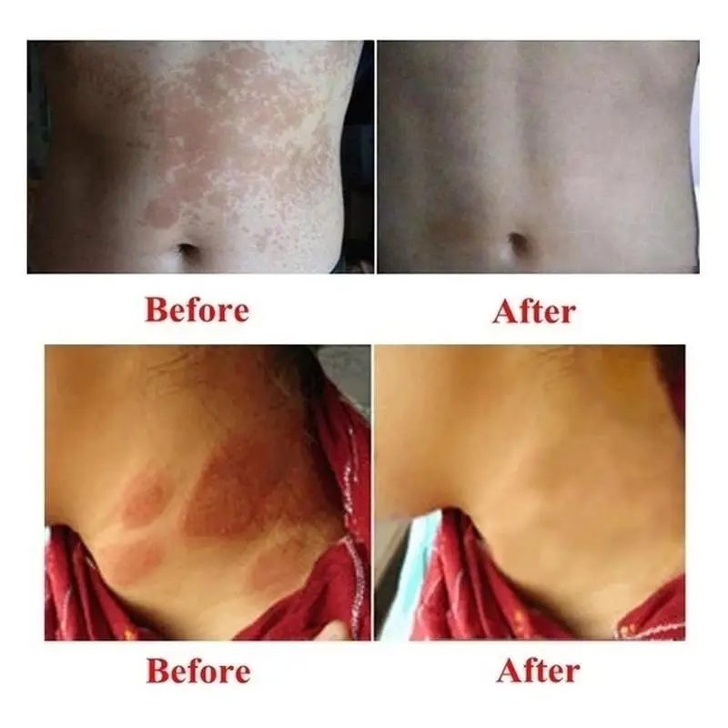 Antibacterial Cream Eczema Ointment Remove Odor Private Part Dermatitis Anti-itch Cream Tinea Cruris Psoriasis Plaster Skin Care