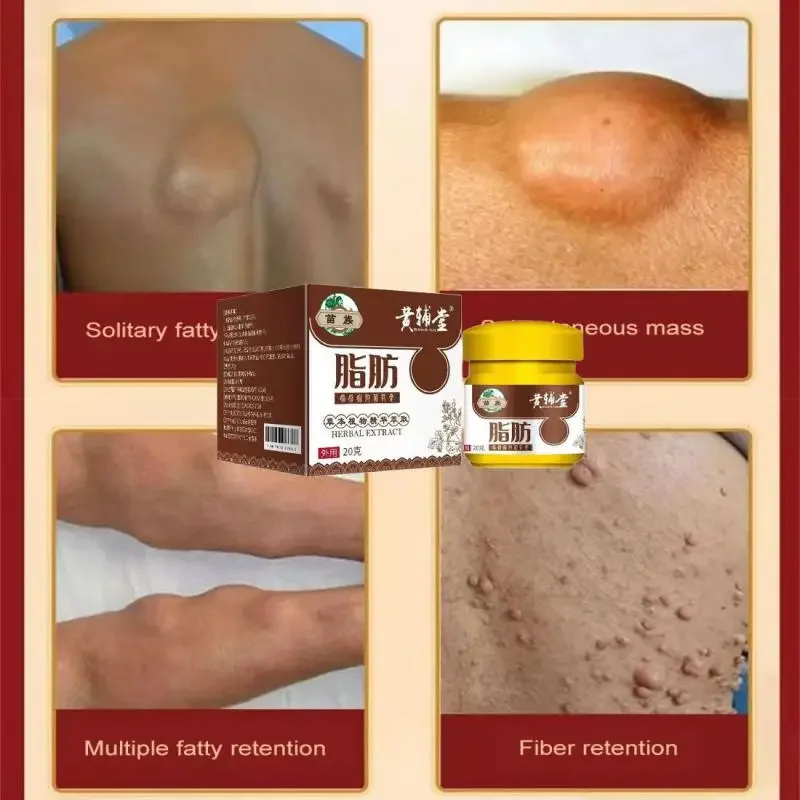 Lipoma Removal Cream 20g Relief Pain Treat Skin Swelling Lipolysis Cellulite Remover Ointment Lipolysis Fat Lump Body Care