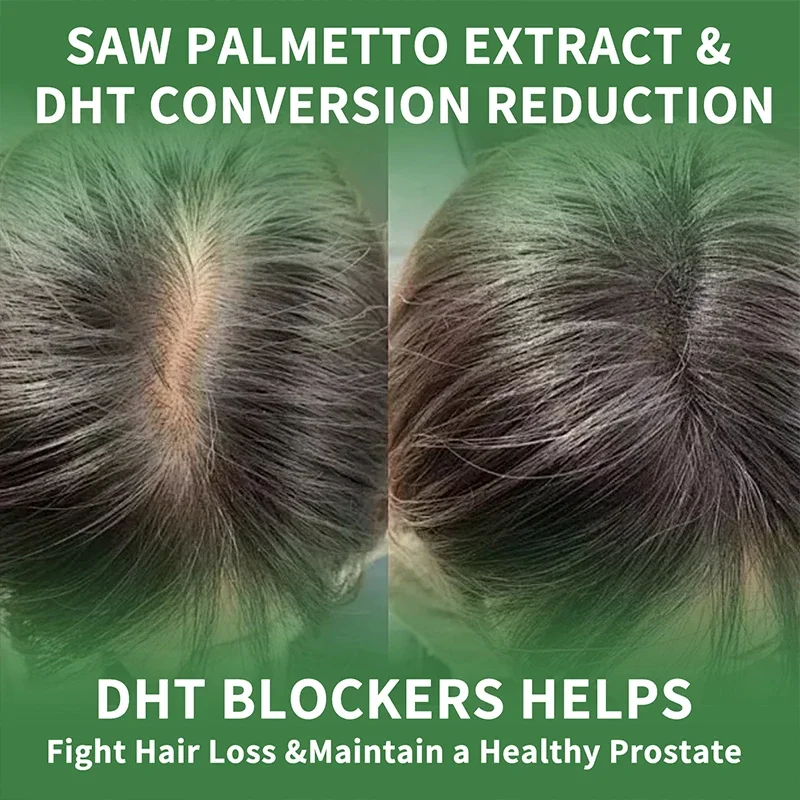 Saw Palmetto-Male Prostate and Reproductive Health Reducing Baldness and Hair Thinning