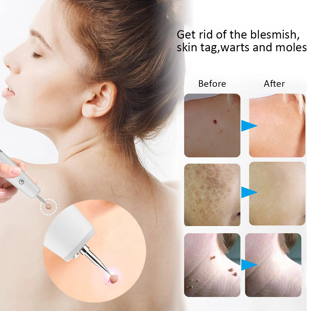 Laser Plasma Pen Electric Skin Tag Remover Tattoo Papilloma Mole Dark Spot Removal Blemish Wart Freckle Eliminator For Face Body