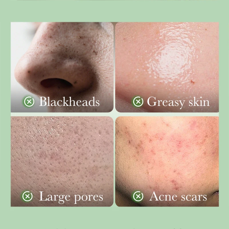 SADOER Salicylic Acid Nicotinamide Facial Masks Anti-acne Whitening Moisturizing Acne Removal Anti-Aging Facial Masks Skin Care