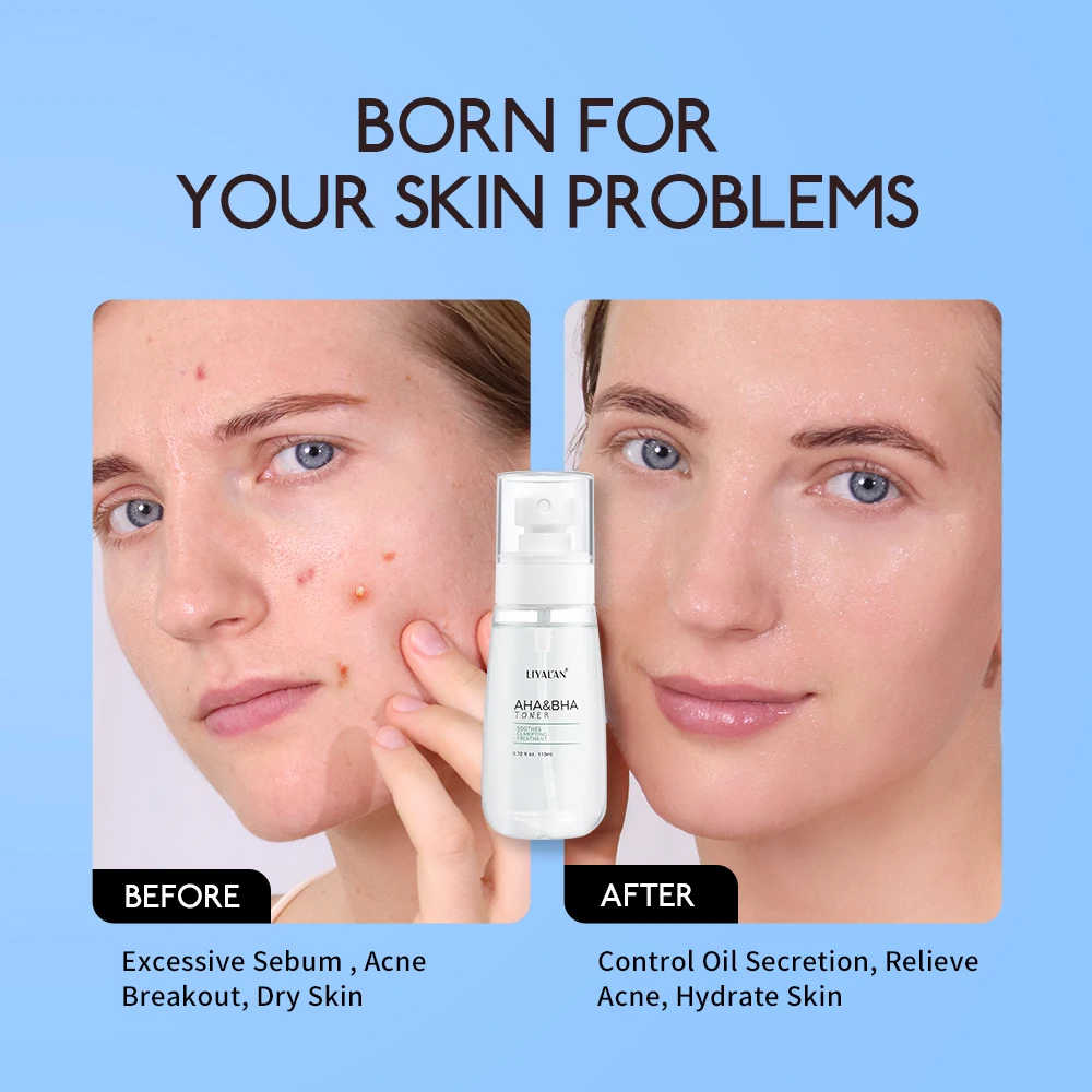 110ml AHA BHA Facial Toner Spray Acne Treatment Clarifying Soothing Skin Lightening Moisturizing Relieving Blackheads Skin Care