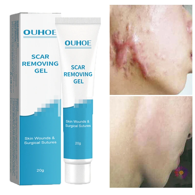 Herbal Scar Removal Cream Stretch Marks Repair Acne Spots Burn Surgical