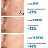 Salicylic Acid Acne Removal Cream Anti-Acne Repair Redness Pimple Spots Deep Cleaning Pore Oil Control Moisturizing Skin Care