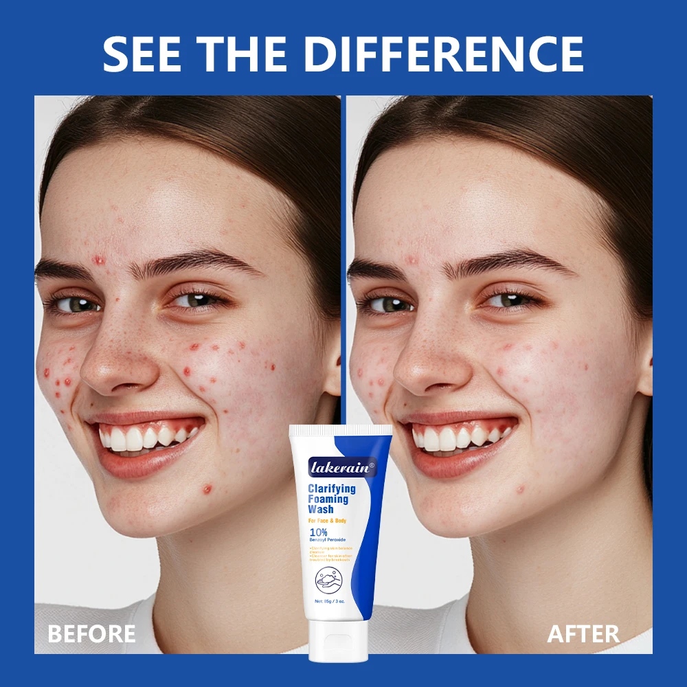 Acne Foaming Wash Benzoyl Peroxide 10% Maximum Antimicrobia Oil-Control Reduces Redness Deep Cleaning for Face & Body Skincare 2