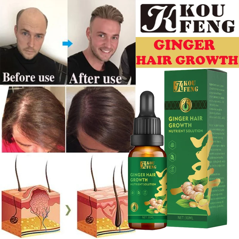 Koufeng Ginger Essential Hair Growth Oil Liquid Anti Hair Loss Baldness