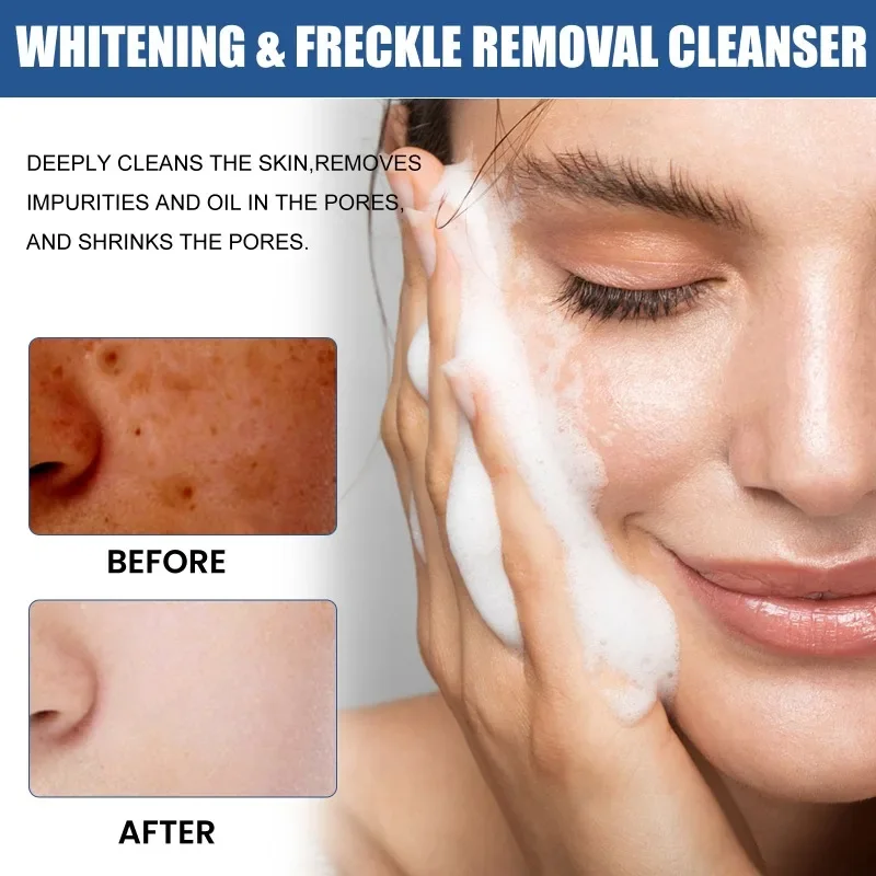 

Sdatter Whitening Freckle Facial Cleanser Remove Melasma Dark Spots fade Melanin clean pores Anti Acne Moisturize Brighten Skin