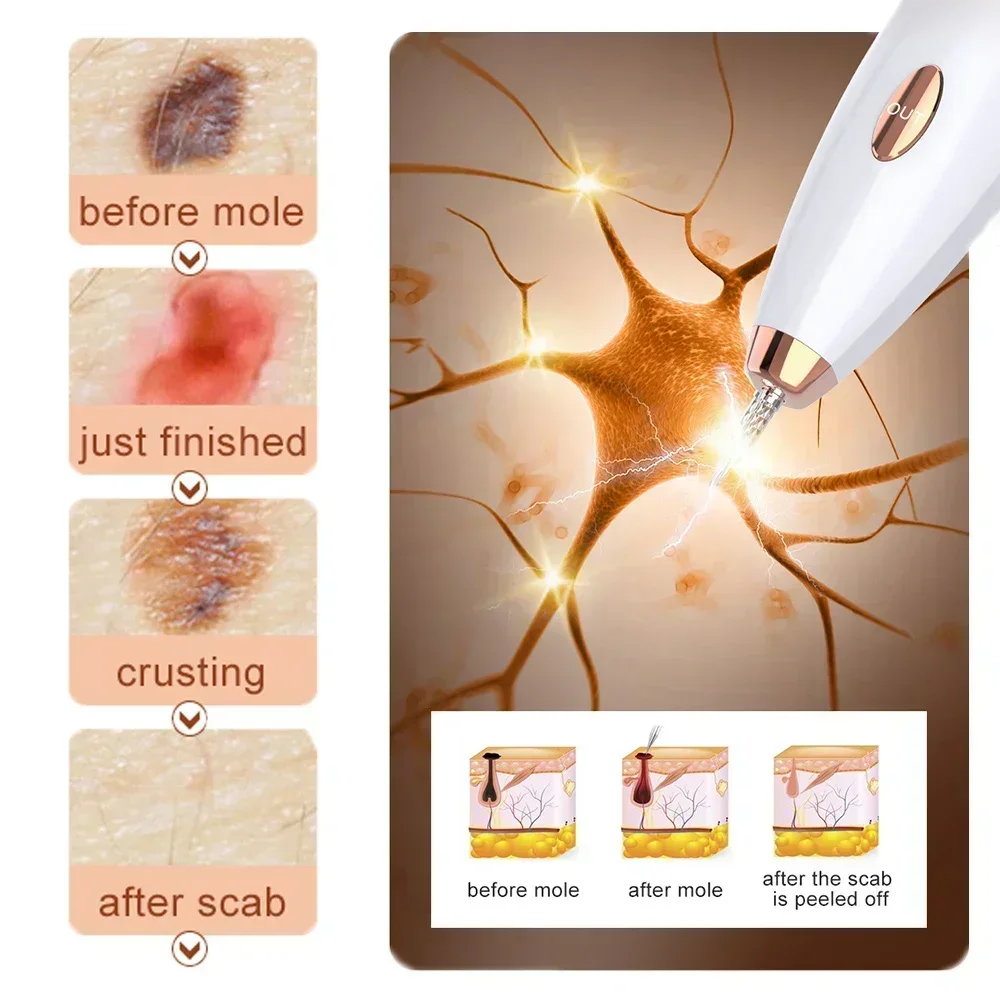 Skin Tag Remover Electric Skin Tags Removal Dark Spot Mole Remover Pen Freckle Wart Tattoo Nevus Black Spots Laser Plasma Pen