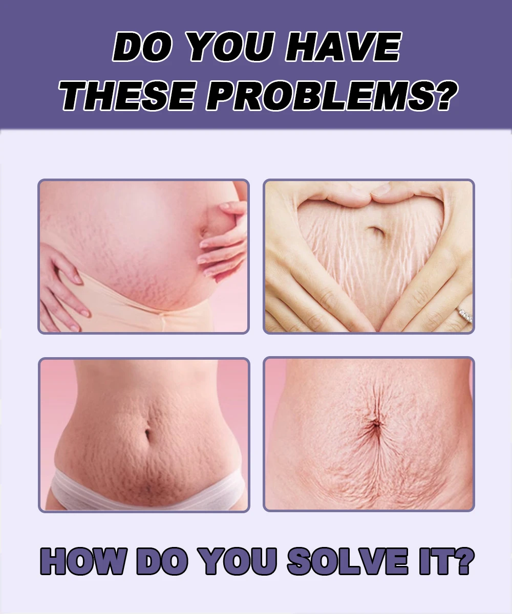 Stretch mark removal cream, Postpartum repair of fat marks on thighs, Stretch mark removal cream