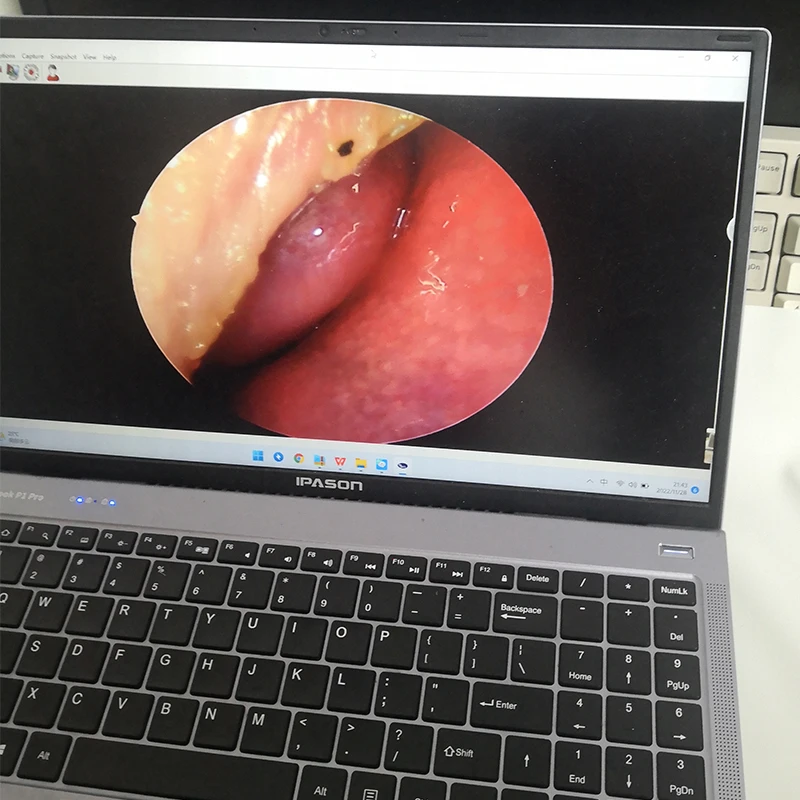 Ultra HD ENT Endoscope 2.7mm Human Body and Pet Support Laptop and TV with USB Interface to Use the Endoscope 6