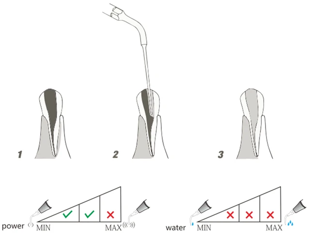 5 Pezzi Woodpecker DTE Inserti Piezo / Punte Per La Pulizia Endodontica  Ed1 Ed2 Ed3 Ed5 Ed5d Ed8 Ed9 Compatibile Con Nsk Satelec Acteon - Foto 2