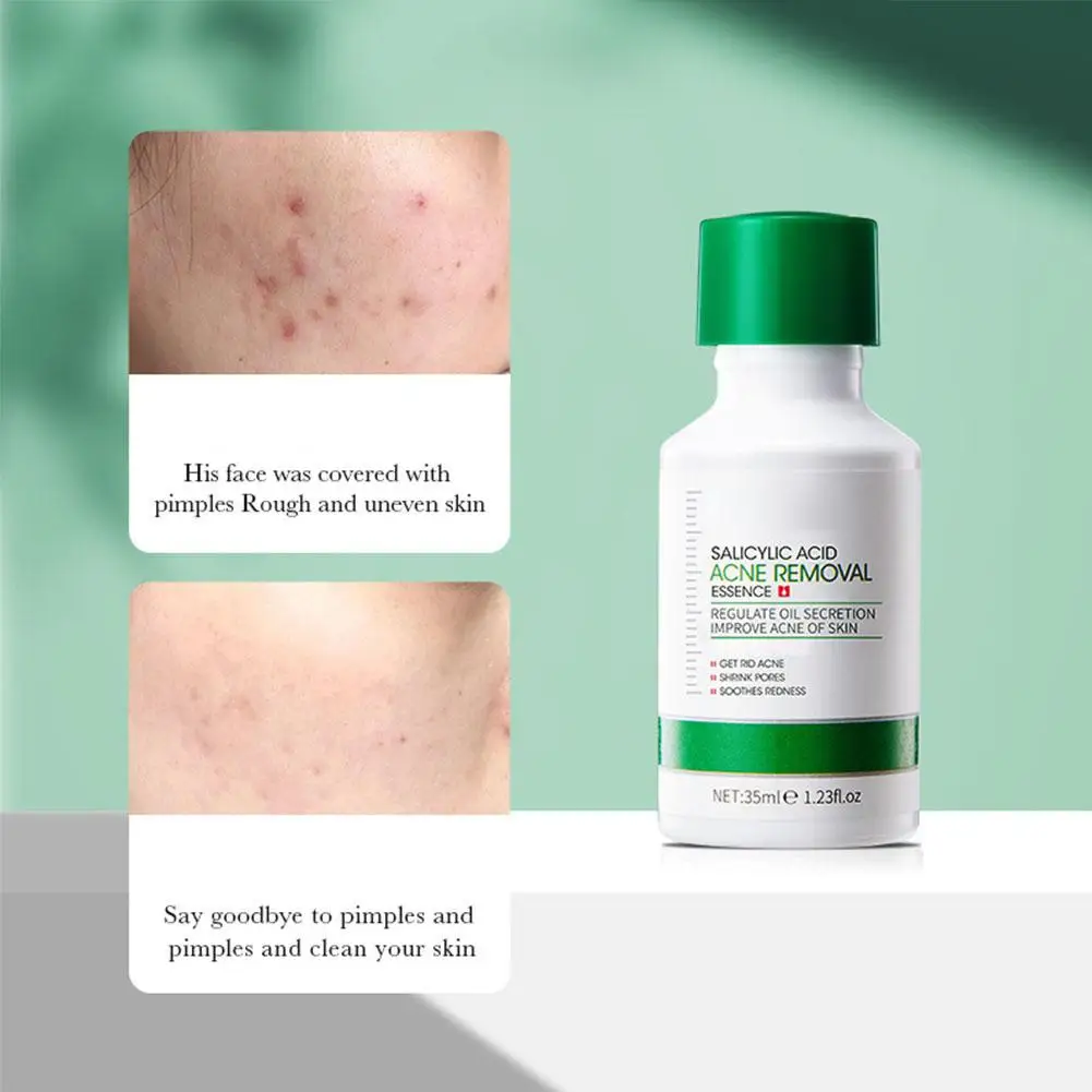35 مللي حمض الساليسيليك حب الشباب إزالة مصل الوجه...