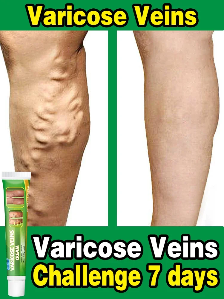 Effective Varicose Vein Relief Cream Ointment for Varicose Veins to Relieve Vasculitis Phlebitis Spider Pain Relief varicose vein ointment