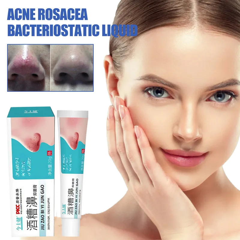 Herbal Anti Nose Mites Remove Acne Rosacea Cream Red Nose Blackhead